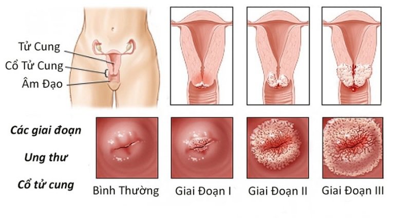 Hình ảnh mô tả các giai đoạn của ung thư cổ tử cung 