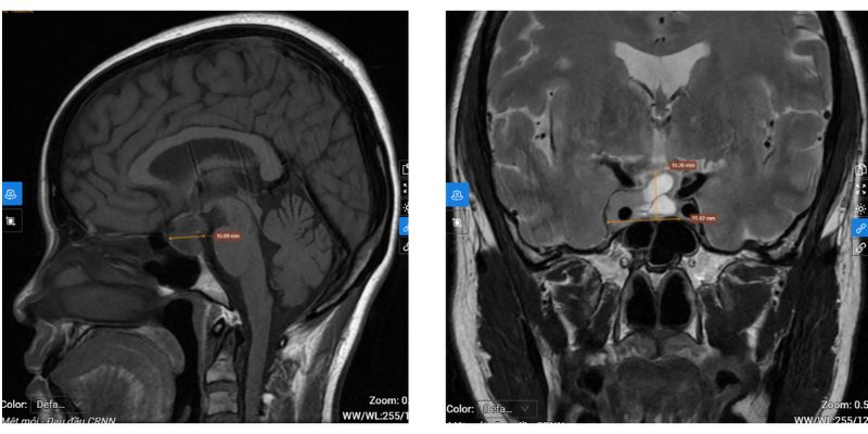 Hình ảnh MRI phát hiện khối u uyến yên bất thường, xâm lấn các cấu trúc lân cận