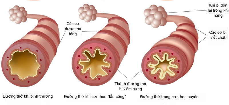 Hình ảnh về sự thay đổi của phế quản người bình thường so với người mắc bệnh hen. Ảnh minh họa 