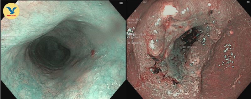 Tổn thương sùi kích thước 3cm bao vòng quanh chu vi trên hình ảnh nội soi của bệnh nhân mắc ung thư dạ dày 