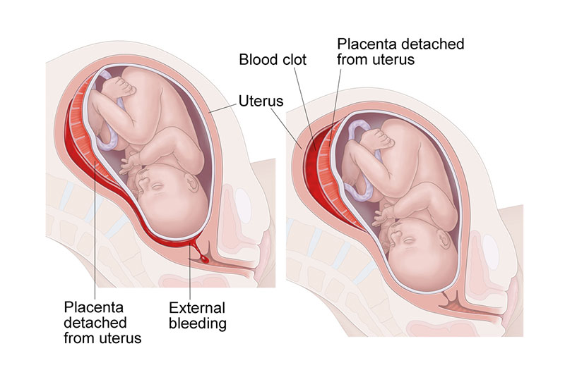 Triệu chứng xuất huyết khi mang thai có nguy hiểm không?