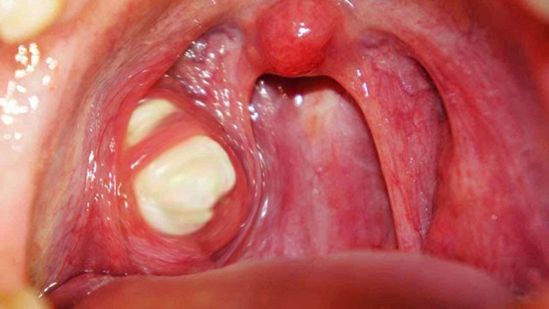 Nguyên nhân gây nổi mụn đỏ ở cổ họng và cách điều trị hiệu quả