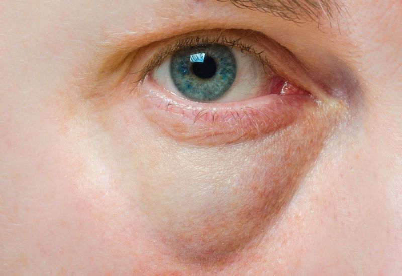 Bị bọng mắt đỏ có cần đi khám chuyên khoa hay sử dụng thuốc không?
