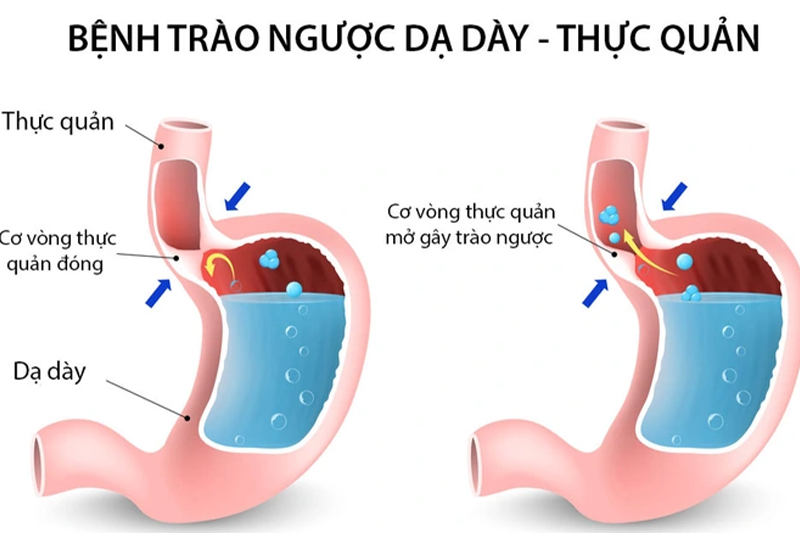 Phân biệt hội chứng trào ngược dạ dày với đau họng