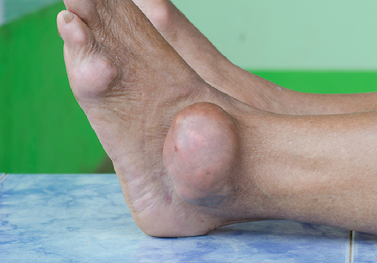 Trong bệnh Gout, tinh thể urat hình thành trong khớp mắt cá chân gây viêm, sưng đau dữ dội.