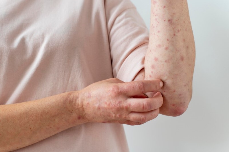 Sẩn ngứa cũng có thể là dấu hiệu của một số bệnh lý toàn thân