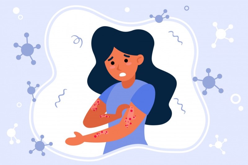 Dị ứng là nguyên nhân hay gặp nhất gây sẩn ngứa