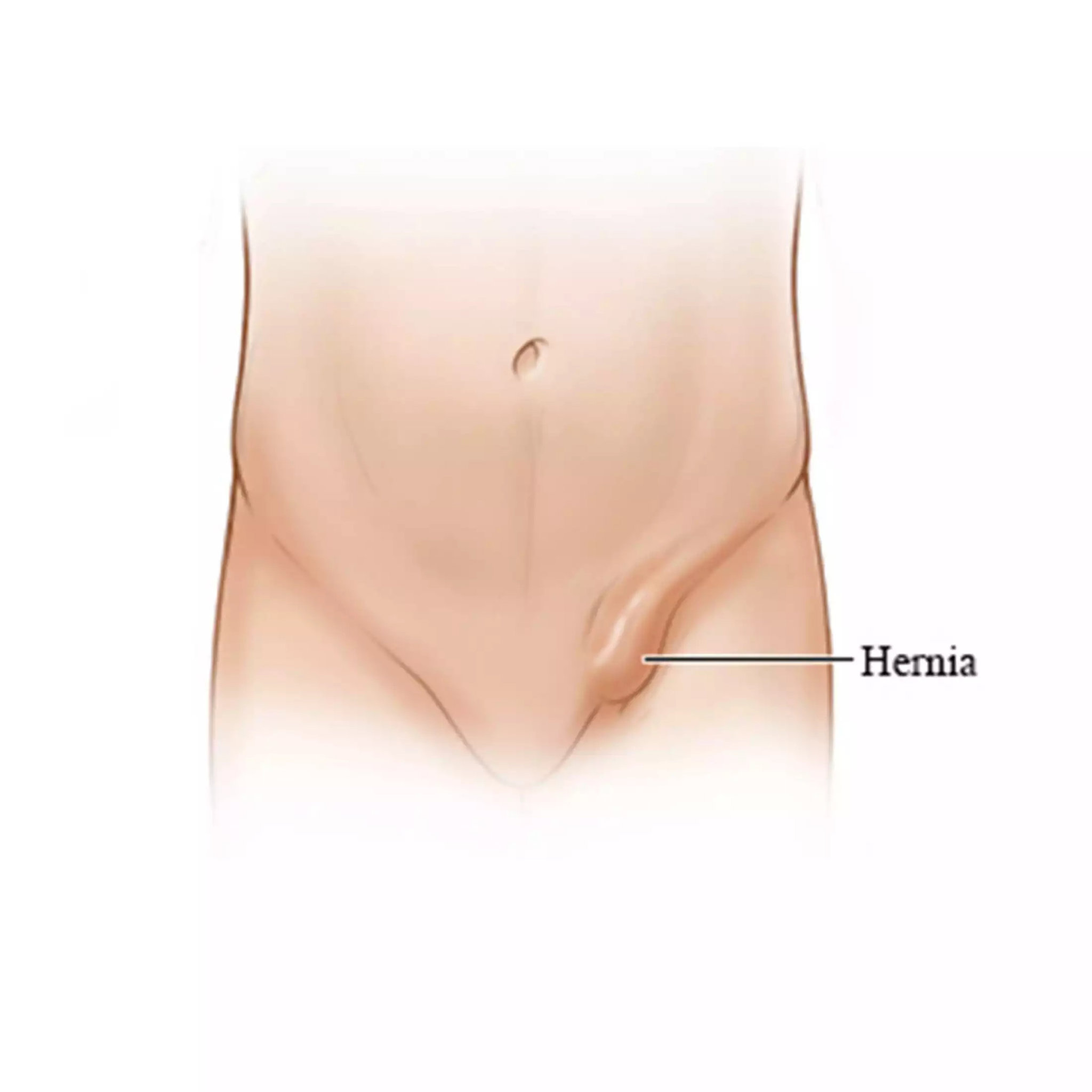 Thoát vị bẹn có thể gặp ở cả nam và nữ nhưng phổ biến hơn ở nam giới