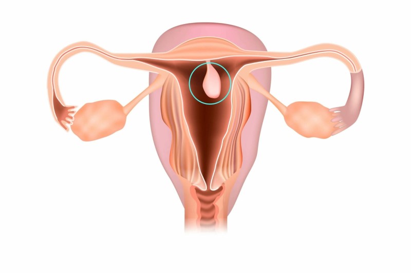 Polyp buồng tử cung là nguyên nhân gây rong huyết