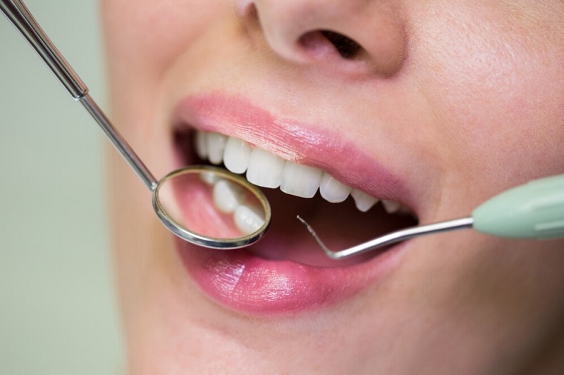 Hàn răng vừa ngăn chặn lây lan sâu răng vừa giúp tăng vẻ đẹp cho răng 