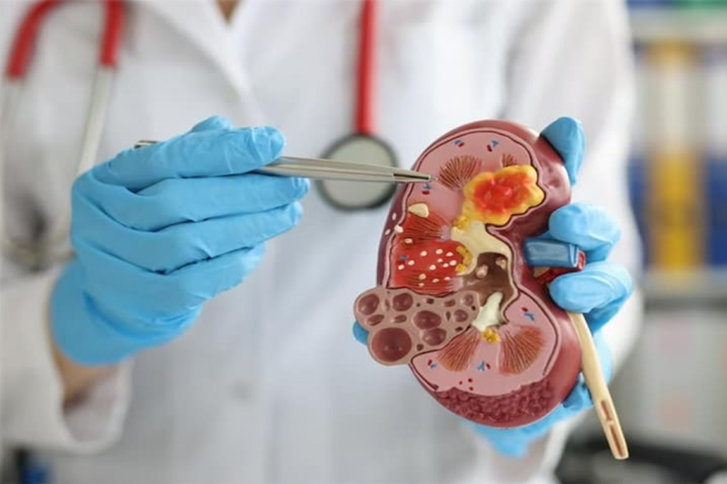 Sinh thiết thận là tiêu chuẩn vàng giúp chẩn đoán bệnh