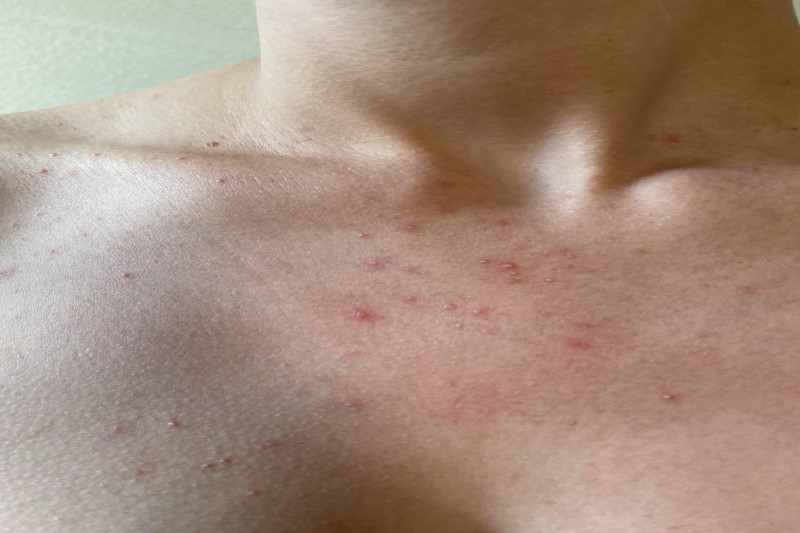  Phát ban ở ngực có thể là biểu hiện của bệnh lý toàn thân