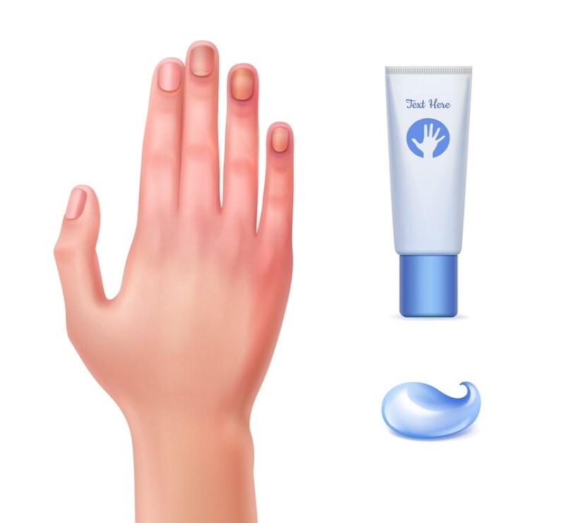 Thuốc bôi ngoài da được kê để điều trị một số bệnh về móng