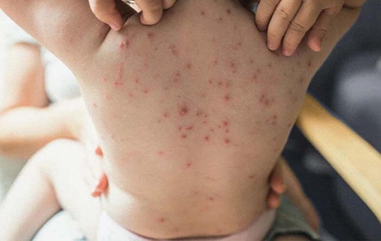 Thuỷ đậu có những điểm tương đồng cần phân biệt với u mềm lây