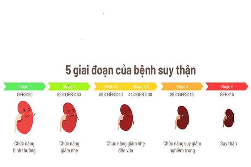 Viêm cầu thận mạn có thể tiến triển thành bệnh thận mạn và bệnh thận mạn giai đoạn cuối