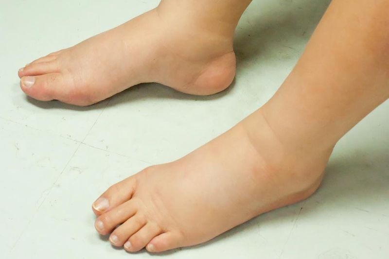 Bệnh nhân viêm cầu thận mạn thường có triệu chứng phù