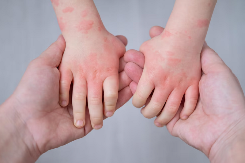 Có nhiều nguyên nhân gây nên tình trạng nổi mề đay ở trẻ
