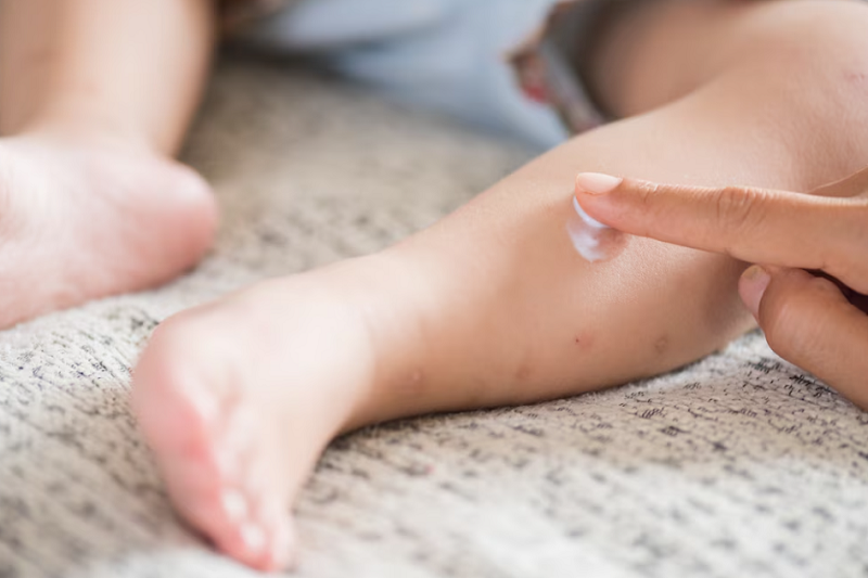 Trẻ nên được dùng kem dưỡng ẩm đúng cách khi bị nổi mề đay