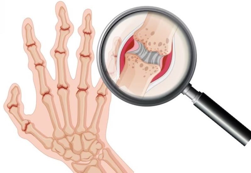 Hình ảnh bào mòn xương trong viêm khớp dạng thấp