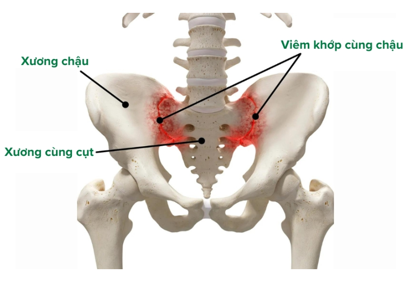 Viêm khớp cùng chậu là tình trạng viêm và đau xảy ra ở một hoặc cả hai khớp cùng chậu.