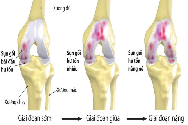 Viêm xương khớp gây ra tình trạng gai khớp gối