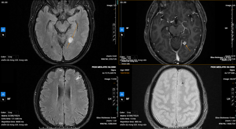 Hình ảnh tổn thương não được phát hiện trên hình ảnh chụp MRI não  