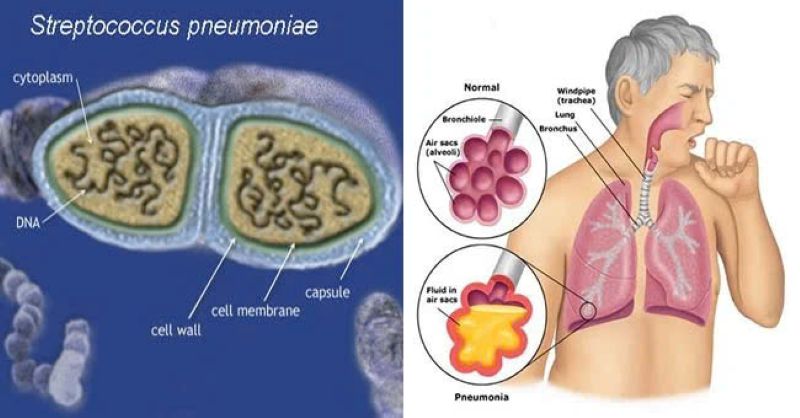 Vi khuẩn streptococcus pneumoniae là “thủ phạm” gây ra nhiều bệnh lý nhiễm trùng khác nhau
