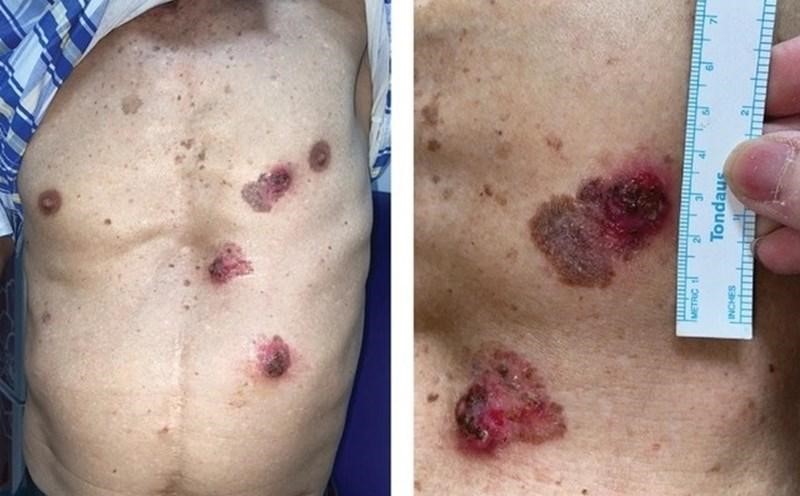 Nốt ruồi cũ thay đổi kích thước, hình dạng, màu sắc bất thường là dấu hiệu nhận biết ung thư da giai đoạn đầu