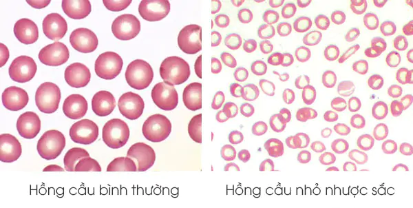 Thiếu máu hồng cầu nhỏ nhược sắc có thể do thiếu máu tán huyết di truyền Thalassemia