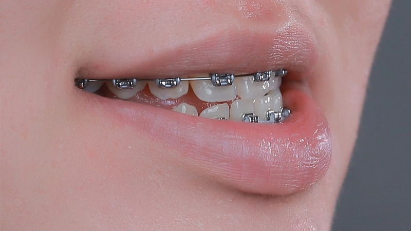 Niềng răng là biện pháp được áp dụng nhằm điều trị tình trạng móm răng ở người lớn 