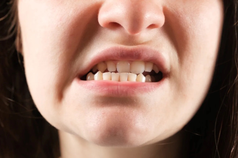 Móm răng ảnh hưởng lớn đến tính thẩm mỹ 