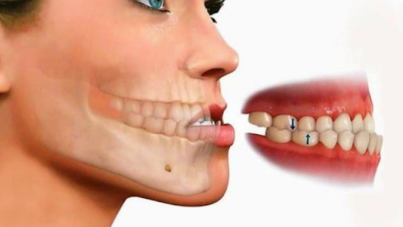 Tình trạng móm răng có thể do yếu tố di truyền 