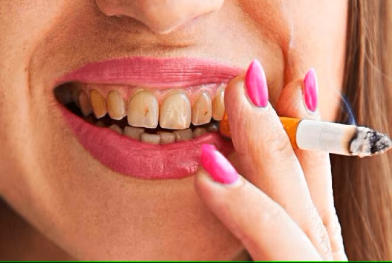 Hút thuốc là nguyên nhân gây tình trạng răng xỉn màu 