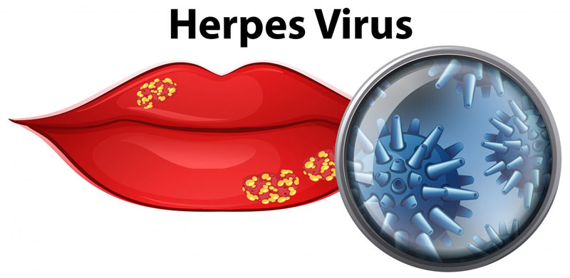 Nổi mụn nước ở môi là dấu hiệu lây nhiễm virus Herpes