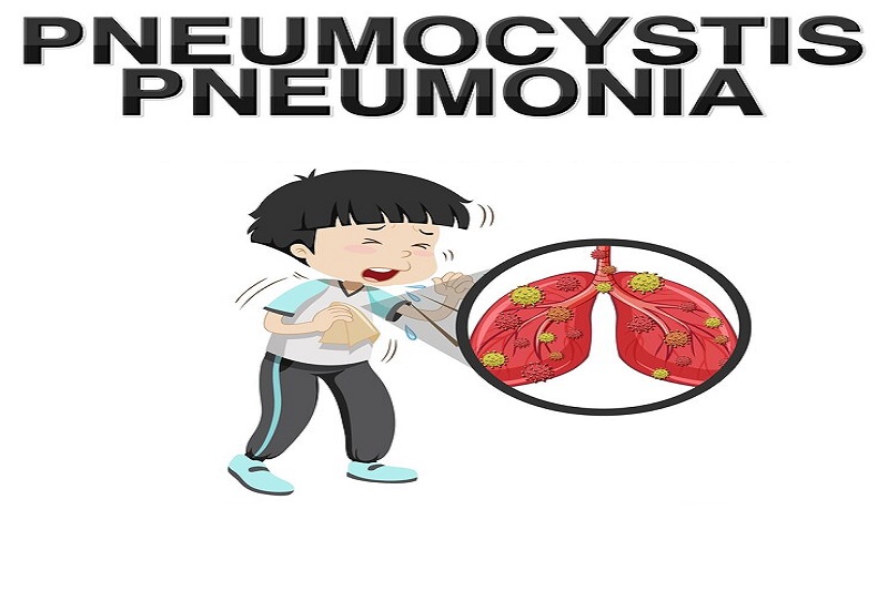 Trẻ bị sởi không được điều trị đúng cách có thể biến chứng viêm phổi