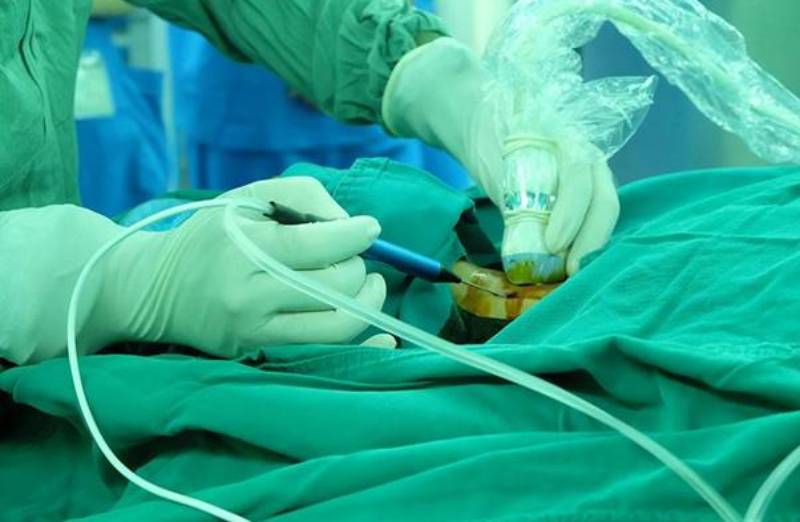 Đốt sóng cao tần tuyến giáp là phương pháp điều trị khối u lành tính được nhiều người lựa chọn