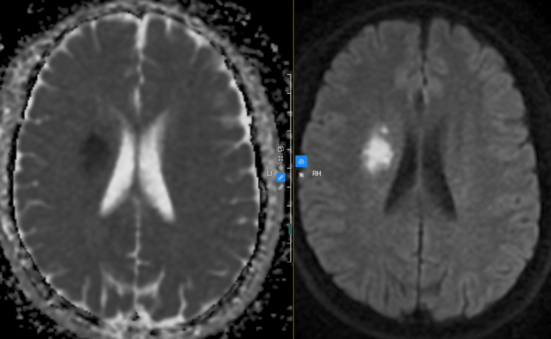 Hình ảnh chụp MRI sọ não của bệnh nhân phát hiện bất thường 