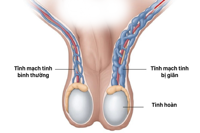 Hình ảnh mô phỏng hiện tượng giãn tĩnh mạch thừng tinh