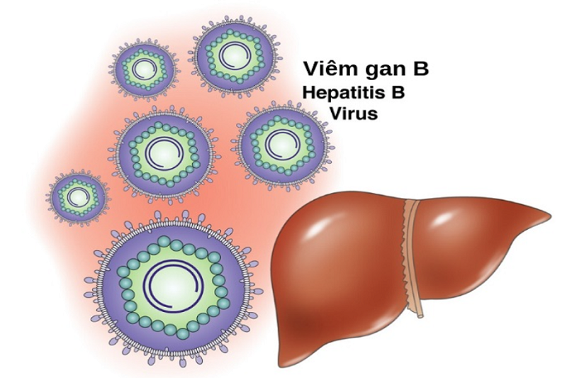 Viêm gan do virus cũng là một trong các nguyên nhân gây gan to