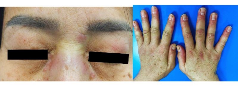 Ban Heliotrope quanh mắt và sẩn Gottron trên khớp ngón tay bệnh nhân T.T.N