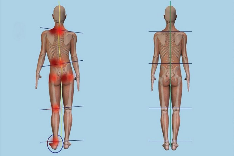 Sai lệch chiều dài hai chân dẫn đến thay đổi tư thế hông khi đi lại, khiến dây thần kinh kéo căng bất đối xứng.
