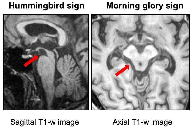 Dấu hiệu “chim ruồi” và “hoa sáng sớm” trên MRI não của người bệnh liệt nhân trên tiến triển.