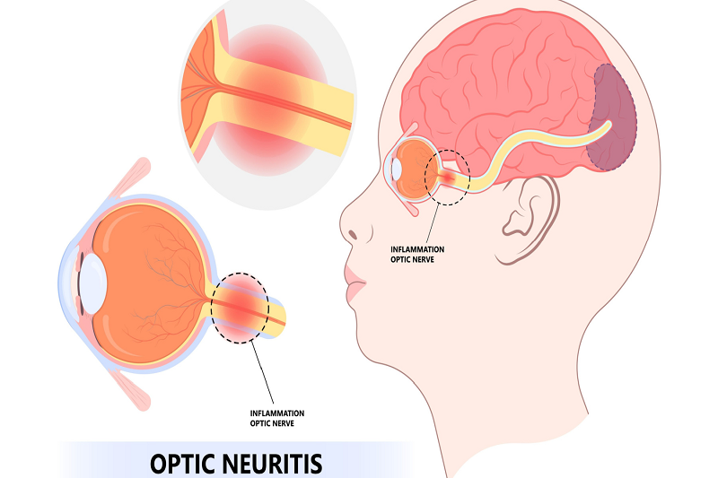 Viêm thần kinh thị giác là một trong những biểu hiện thần kinh phổ biến nhất liên quan đến các bệnh lý tự miễn.