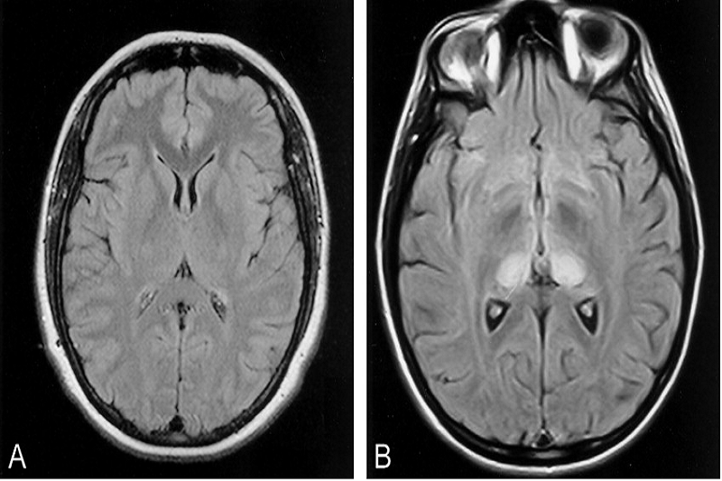 Dấu hiệu “Pulvinar sign” đặc trưng của bệnh trên MRI não.