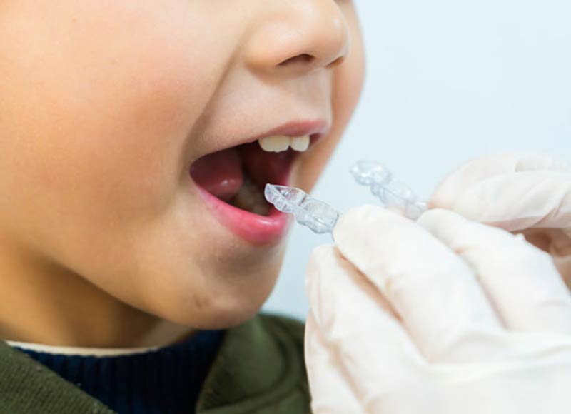 Niềng răng trong suốt là kỹ thuật mới mang lại nhiều ưu điểm vượt trội 