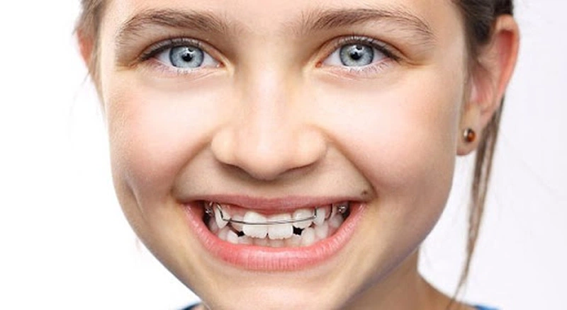 Niềng răng giúp cải thiện tính thẩm mỹ và mang lại sự tự tin cho trẻ 