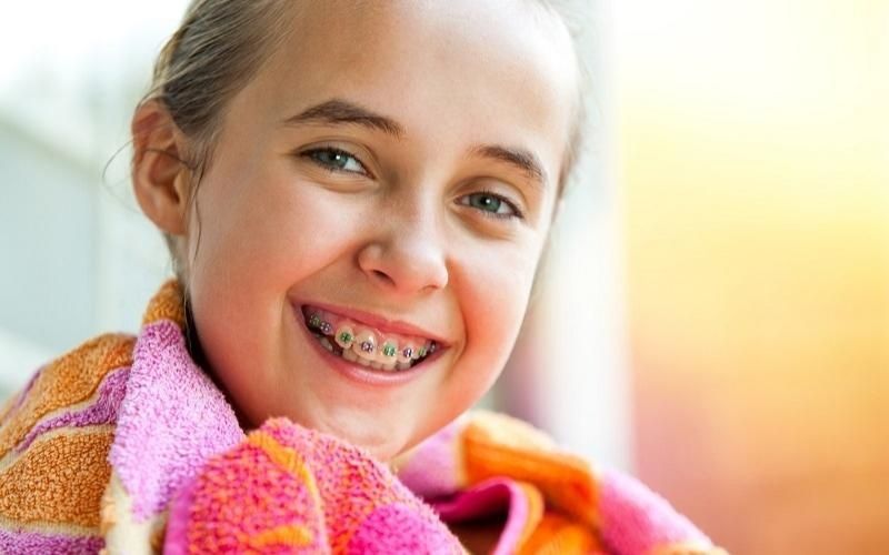 Độ tuổi niềng răng cho trẻ mang lại hiệu quả là 12 đến 16 tuổi