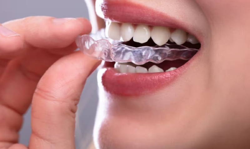 Máng chống nghiến răng được sử dụng để bảo vệ răng hiệu quả 