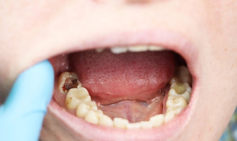 Vệ sinh răng miệng không đảm bảo khiến trẻ bị sâu răng hàm 
