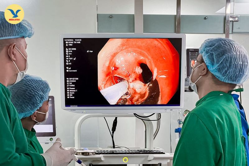 Cắt tách niêm mạc (ESD) đặc biệt hiệu quả trong điều trị ung thư thực quản giai đoạn đầu